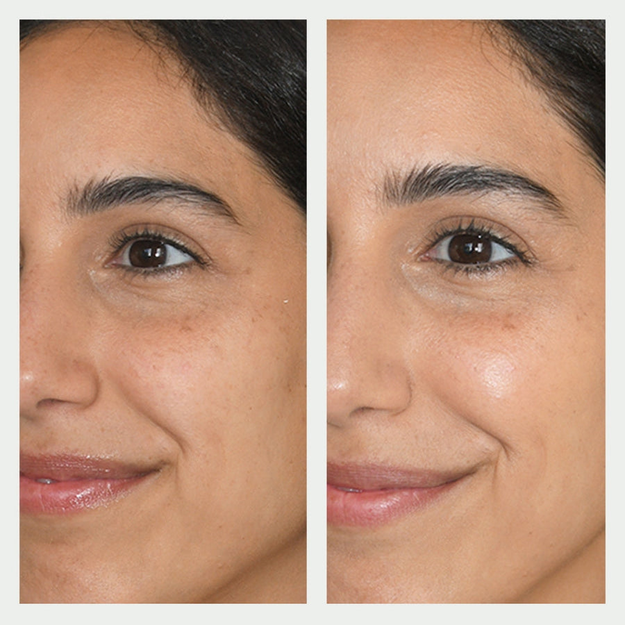 Resurfacing Mask Before and After 1