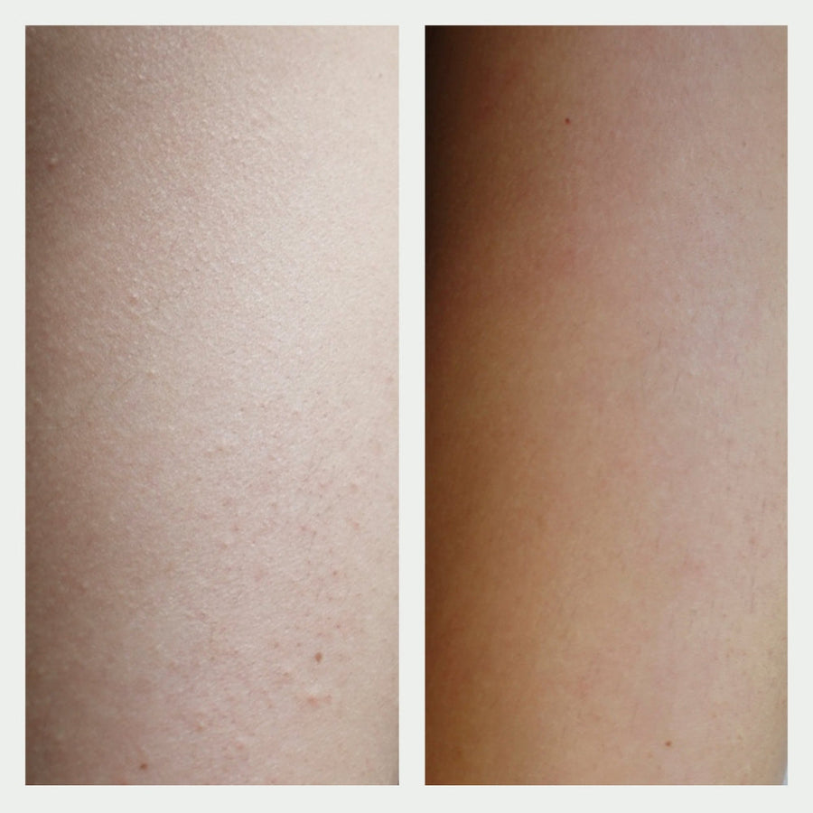 Resurfacing Body Serum Before and After 2