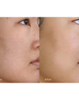 Resurfacing Mask Before and After 3