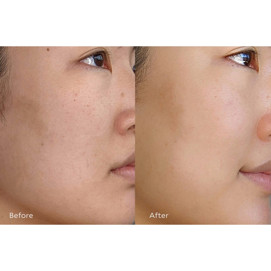 Resurfacing Mask Before and After 3