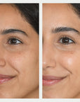 Resurfacing Mask Before and After 1